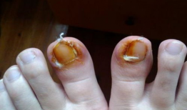 甲沟炎修脚视频,专业指导，轻松告别脚部困扰